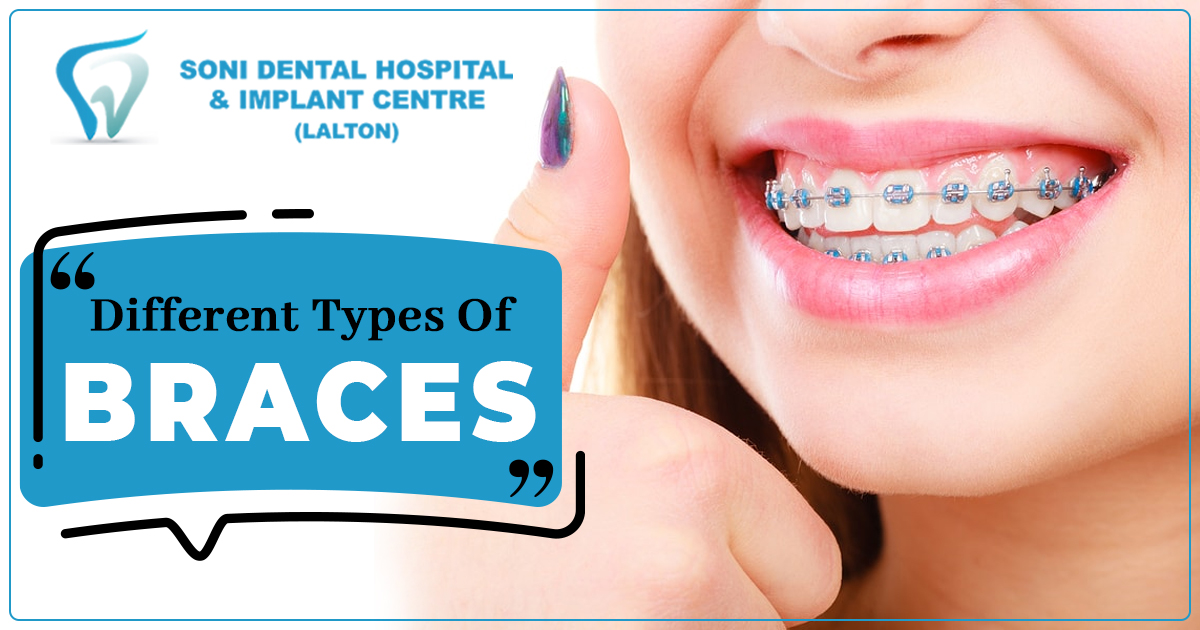 What are different kinds of braces and how to select the best one?