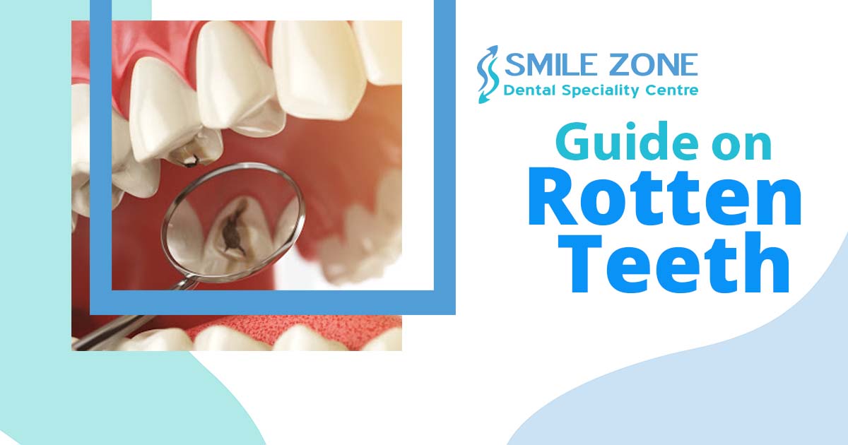 What do you need to know about causes and treatment for rotten teeth in children?